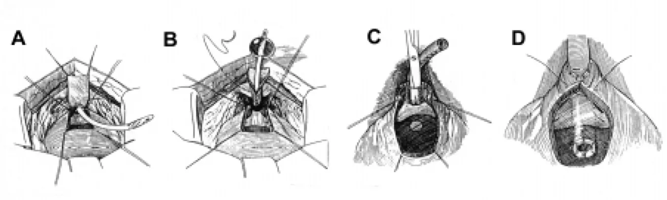Figure 6 - Diagram of the Kropp bladder neck reconstruction. A) and B) The bladder is opened and a strip of anterior bladder wall in continuity with the bladder neck is excised and rolled into a tube over a catheter