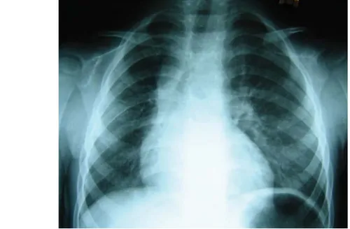 Figura 1. Telerradiografia do torax com assimetria dos campos pulmonares e desvio do mediastino para a direita.