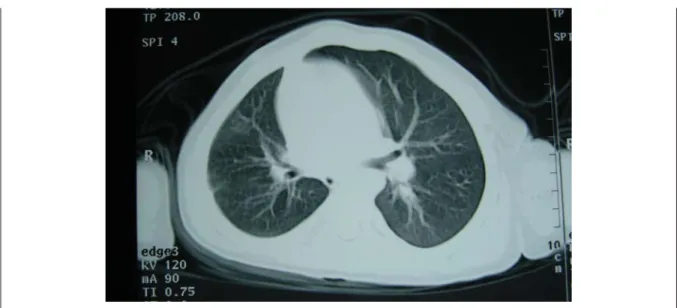 Figura 2.  TAC torácico revelando ausência da artéria pulmonar direita e hipoplasia pulmonar ipsilateral.