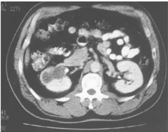 Figure 1 – Abdominal computerized tomography, showing hypodense image in right kidney, with inner calcification,  sug-gestive of cystic mass.