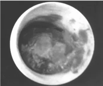 Figure 2 – Sagittal contrast-enhanced T1-weighted MRI image demonstrating a posterior periurethral mass (arrow) consistent with leiomyoma.
