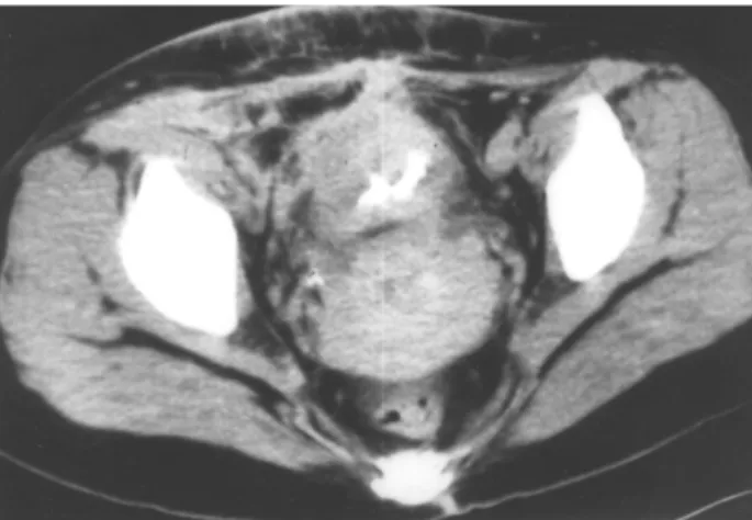 Figure 1 – Computed tomography (CT) showing a predominantly right-sided mass involving the anterior abdominal wall, small bowel and dome of the bladder.
