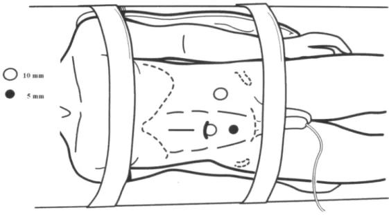 Figure 2 – Positioning, trocars and incision in hand-assisted technique for laparoscopic retroperitoneal lymphadenectomy.
