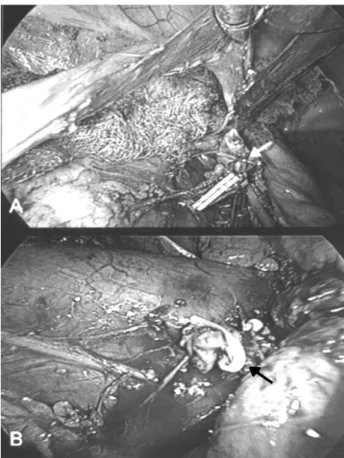 Figure 2 – Left retrograde injection of contrast medium demonstrating extravasation into the peritoneum.