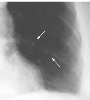 Figure 2 – CT scan of the chest revealing diffuse interstitial fi- fi-brosis (arrows).