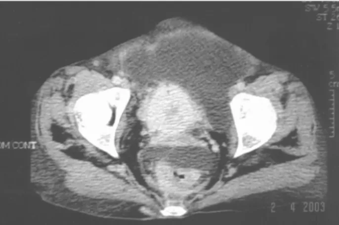 Figure 1 – Abdominal computerized tomography showing bilat- bilat-eral hydronephrosis and voluminous ascites.