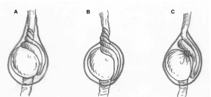 Figure 1  – Classification of types of testicular torsion. A) Intravaginal torsion; B) Extravaginal torsion; C) Torsion due to long mesorchium.