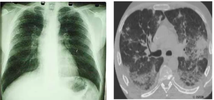 Fig. 1.3. Aspergilose pulmonar em doente transplantado. Observa- Observa-se uma maior expressividade radiográfica na TAC (imagem direita)  do  que  na  radiografia  simples  (imagem  esquerda)  (adaptado  de  García-Ruiz et al