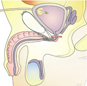 Figure 3 – Schematic drawing of a schematic sagital section showing how the sutures are passed and fixed anteriorly and posteriorly to the pubis.