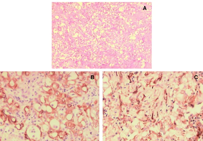 Figure 1 – Histological and immunohistochemical studies of the adenomatoid tumor of adrenal gland