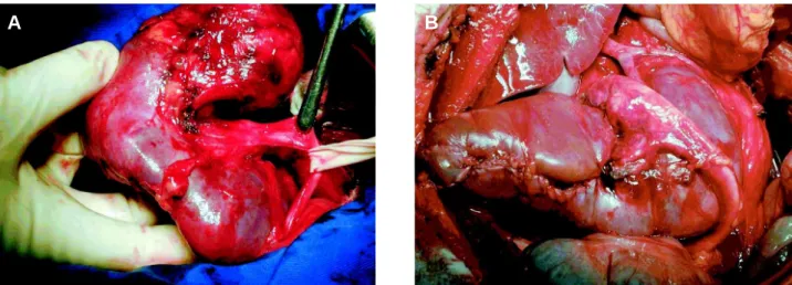 Figure 2 –  A) Intraoperative aspect of horseshoe kidney with tumoral lesion in the upper pole of right kidney