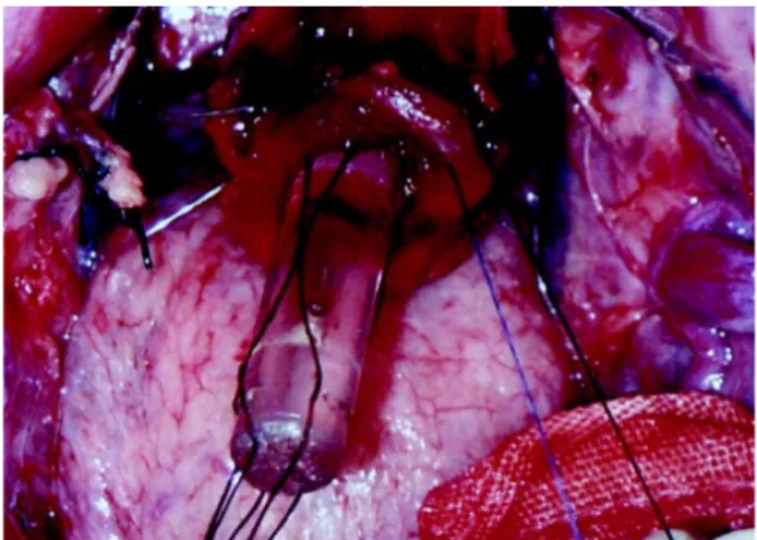 Figure 9 – All stitches passed in the urethral stump.