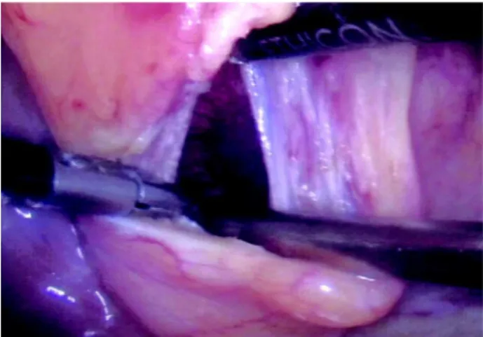 Figure 1 – Initial laparoscopic viewing of the bladder following umbilical puncture (0-grade optics).