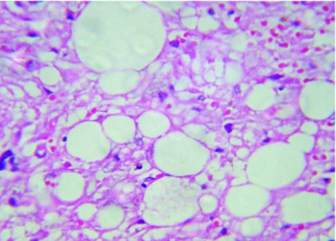 Figure 2 – Histopathological study demonstrating renal pleo- pleo-morphic liposarcoma