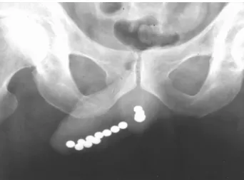Figure 1 –  X-ray of the pelvis showed multiple metallic objects approximately 1 cm in diameter in the anterior and posterior urethra.