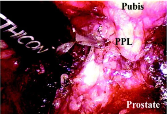 Figure 2  – Opening of endopelvic fascia (EF). The assistant pulls the prostate to the contralateral side and the surgeon  sec-tions the endopelvic fascia with scissors.