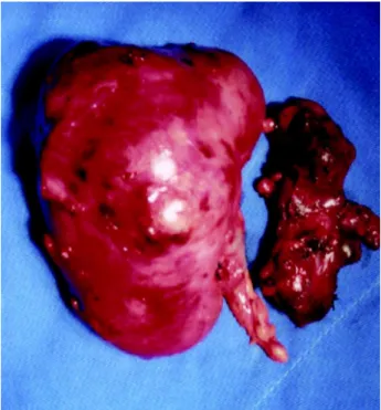 Figure 2 – Surgical specimen from right radical nephrectomy and regional lymphadenectomy.