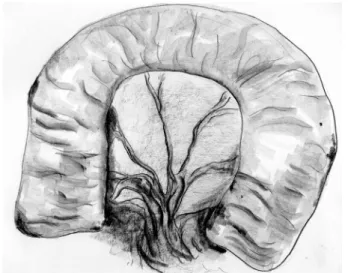 Figure 2 – Final of dissection separating the seromuscular layer from the mucosa.