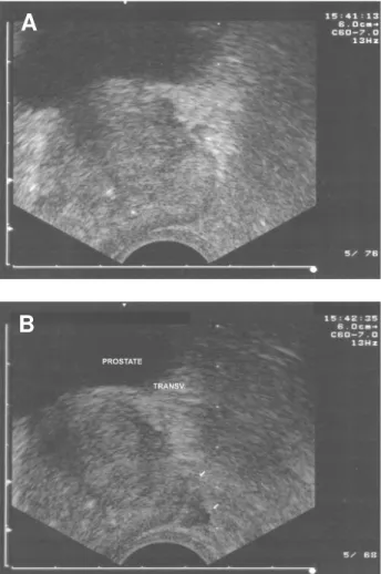 Figure 1 – Ecographic transversal images of the prostate base, pre-injection (A) and post-injection (B) of solution in the  peripro-static region.