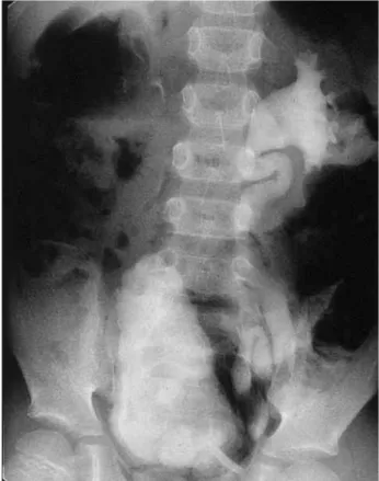 Figure 1 – Picture of the dilated left ureter and the thick-walled bladder and the Christmas-tree shaped bladder of the 7  years-old boy.