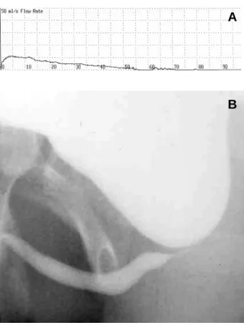 Figure 2 – Urinary flow (A) and voiding cystourethrogram (B) of the 11 year-old boy before treatment.