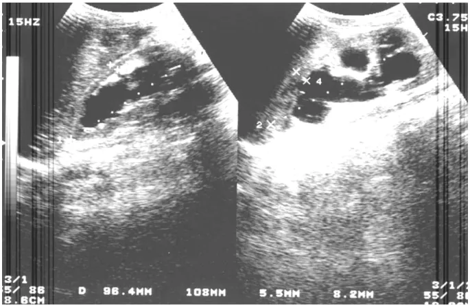 Figure 4 – Ultrasound of the hydroureteronephrosis and thinned parenchyma of the 11 year old boy.