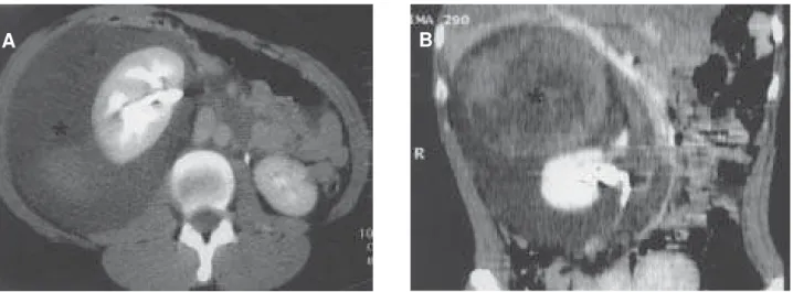 Figure 1 -  A) Computerized tomography (CT) of abdomen with contrast medium evidencing a voluminous retroperitoneal hematoma in the peri-renal area (*)