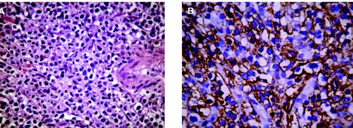 Figure 2 – A ) Photomicrography showing a diffuse large cell lymphoma infiltrating the vesical wall