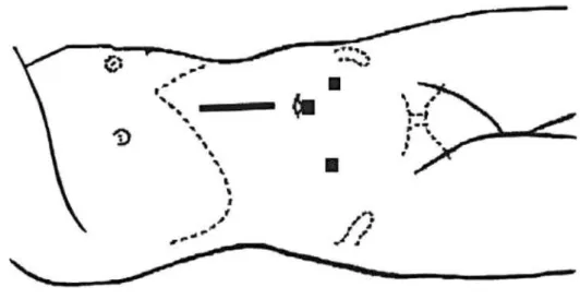 Figure 2  –  Bilateral nephrectomy: position of the laparoscopic ports and the manual incision.