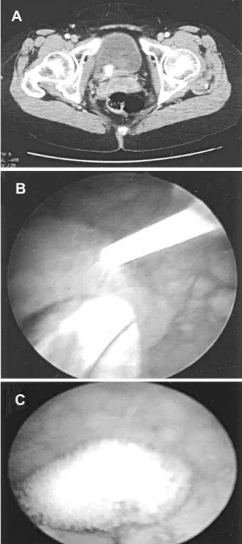 Figure 1 –  A) Cystoscopic view of possible bladder tumor. Bullous edema surrounding ureterocele mimics bladder tumor
