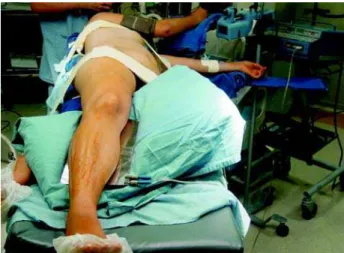 Figure 1 – The patient is placed in the 45-degree left lateral decubitus position with slight flexion of the operating table to extend the ipsilateral flank gently.