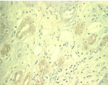 Figure 1 – Immunohistochemistry shows positivity to Ulex Eu- Eu-ropean agglutinin 1 lectin, which strongly supports the  diagno-sis of CDC.