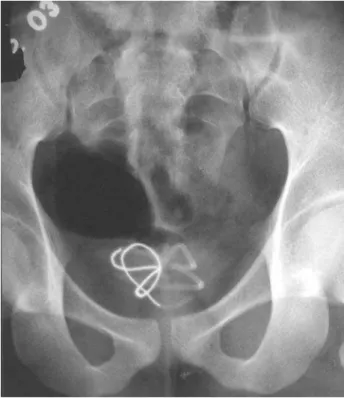 Figure 1 – X-ray of the pelvis showing coiled up wire in urinary bladder.