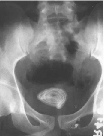 Figure 3 – X-ray of the pelvis showing coiled up wire in the urinary bladder.