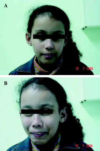Figure 1 – Typical facial grimaces associated with Ochoa syn- syn-drome.