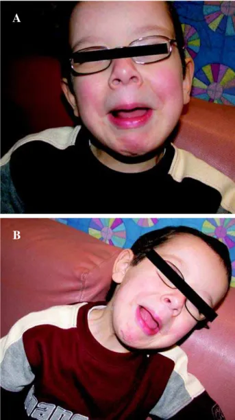 Figure 2 – Typical facial grimaces associated with Ochoa syn- syn-drome.