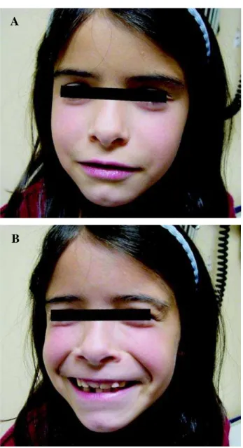 Figure  5 – DMSA shows foci of decreased cortical function in both kidneys.