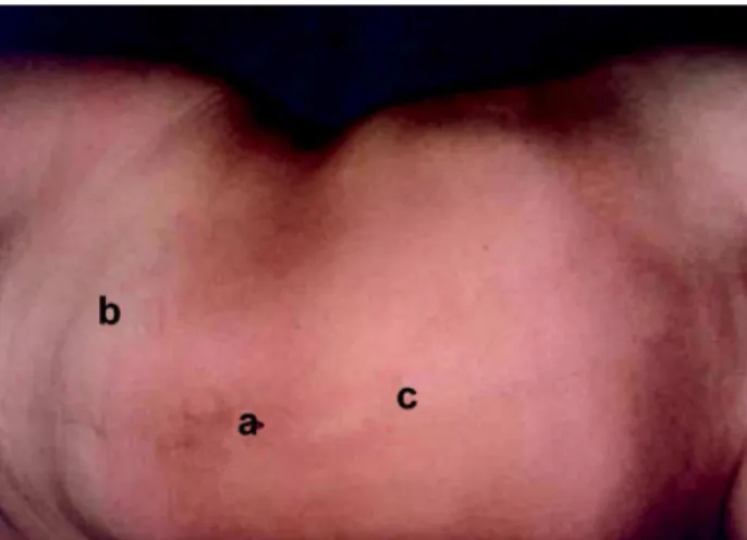 Figure 1 – Computerized tomography showing the abdominal wall defect in the lumbar region.