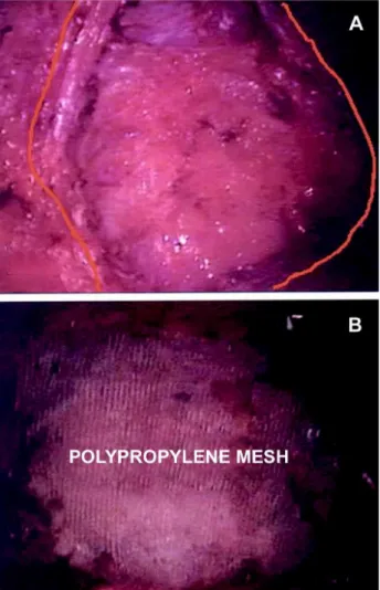 Figure 3 – A) Transillumination of herniation area through the peritoneal cavity. B) Planning of polypropylene mesh size.