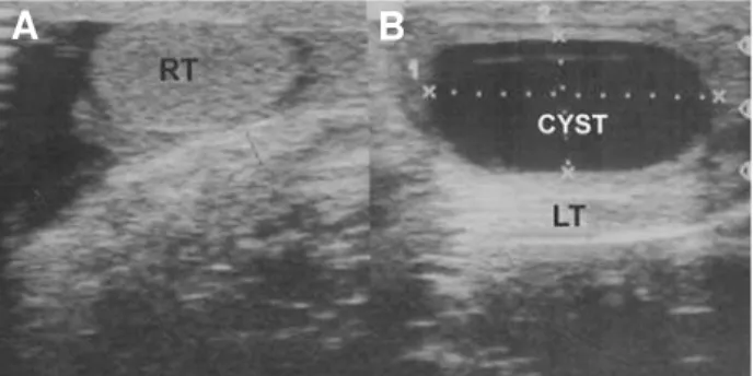 Figure 1 – Preoperative ultrasound assessment. A) Normal right testis (RT). B) Cyst and compressed left testis (LT).