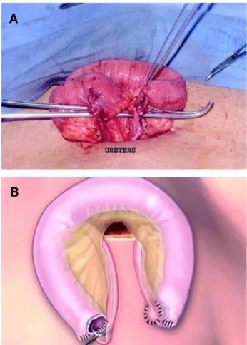 Figure 1  – Photograph showing intact surgical specimen: blad- blad-der (B), prostate (P) and lymph nodes (L).