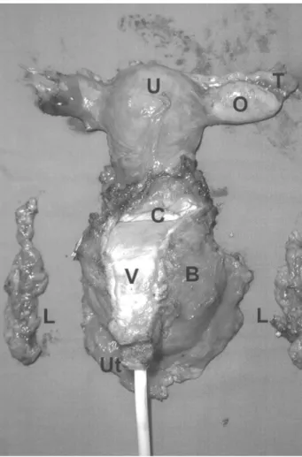 Figure 1 – Posterior view of the intact surgical specimen including, uterus (U), uterine cervix (C), tube (T), ovary (O), anterior vaginal wall (V), bladder (B), urethra (Ut), bilateral lymphatic package (L).