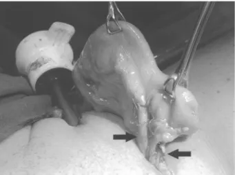 Figure 2 – Re-implanted ureters (arrows) and ileal loop exteriorized through the right side working port site.