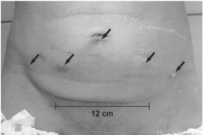 Figure 3 – Photography of port site incisions (arrows) and 12 cm Pfannenstiel incision took on postoperative day 21 when the patient was discharged.