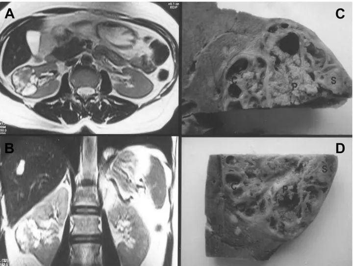 Figure 1 –  A) Magnetic resonance imaging depicting the lesion in right kidney, in transversal and B) frontal sections