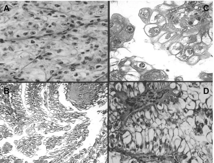 Figure 2 – Sequence of photomicrographies. A) Solid tumoral area, containing cells with clear, finely granular cytoplasm (HE, X200).