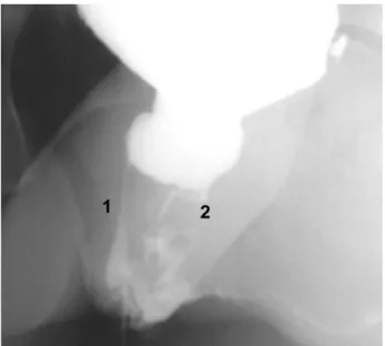 Figure 2 – Voiding cystography. On the left is evident accessory urethra distally ending in a cul-de-sac close to perineum [1]
