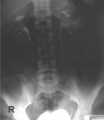 Figure 7 – IVP of the patient with distal ureteral obstruction and ureterovaginal fistula, performed 1 year postoperatively revealed normal left distal ureter and resolution of the hydronephrosis.