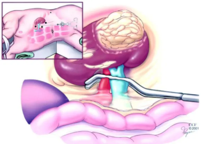 Figure 1 – Transperitoneal technique of laparoscopic partial nephrectomy. Laparoscopic Satinsky clamp is used to obtain en bloc control of renal hilum