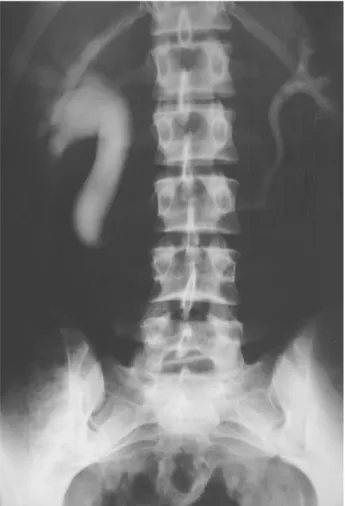 Figure 1 – Excretory urography showing proximal uretero-hy- uretero-hy-dronephrosis and typical “J” configuration of retrocaval ureter.